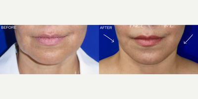 Woman treated with Facelift - Woman treated with Facelift