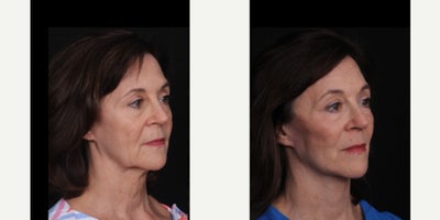 65-74 year old woman treated with Facelift, Neck Lift, Facial Fat Transfer - Love the subtle changes that an isolated face and neck lift with some fat grafting can bring! Our beautiful patient is now 8 months after surgery and continues to heal so well. Thanks to her for allowing us to share these photos!