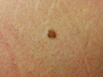 A mole I had removed has grown back and is itchy. Should I go see my ...