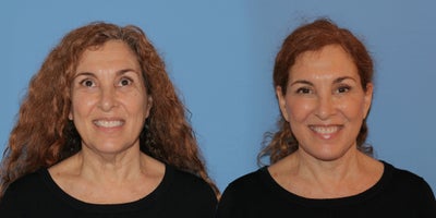 Woman treated with Deep Plane Facelift - Woman treated with Deep Plane Facelift