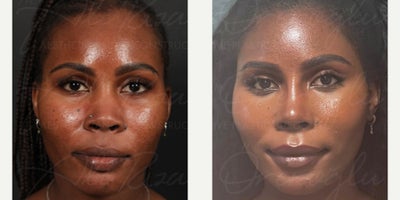 25-34 year old woman treated with African American Rhinoplasty - 25-34 year old woman treated with African American Rhinoplasty