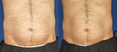 Velashape - Photos provided courtesy of Syneron