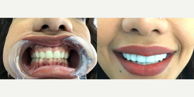 Internal Tooth Bleaching - Veneers are thin coverings that are placed over the front (visible) part of the tooth. They look like natural teeth. Veneers can be used to correct a wide range of dental issues, such as: teeth that are stained and can't be whitened by bleaching. At Clinicexpert you will have the best treatment. Call now or send us a message to get more information.