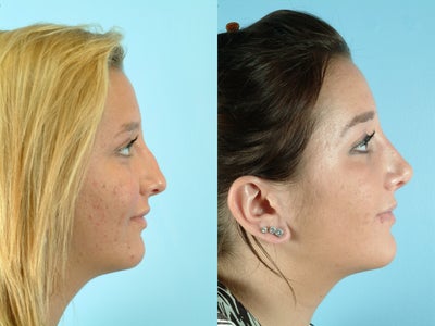 17 Year Old Female Treated for Deformity of the Nose and Nasal Obstruction - 
	17 Year Old Female

	Diagnosis: Deformity of the Nose and Nasal Obstruction

	Procedure: Open Rhinoplasty and Septoplasty
