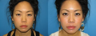 33 yr old woman using Latisse - 
	This is a 33 yr old woman who wanted thicker and longer eyelashes. Latisse was used to achieve this.
