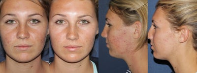 Before & After Fraxel Restore - 1 month after a single photodynamic therapy treatment for acne