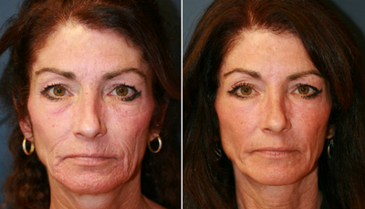 Laser Skin Smoothing (Resurfacing)  - Before and three months after full face carbon dioxide laser skin peel (resurfacing), Steve Laverson, MD, Plastic Surgeon&nbsp;