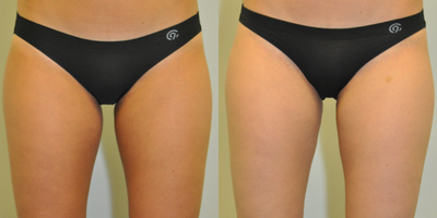 28 year old woman treated with CoolSculpting - 28 year old female 3 months after CoolSculpting of the inner thighs.