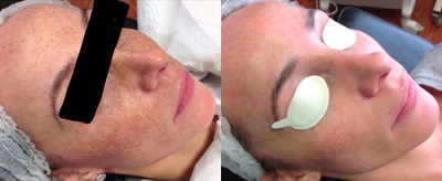35-44 year old woman treated with Skin Rejuvenation - Picosure skin rejuvenation after 4 treatments.
