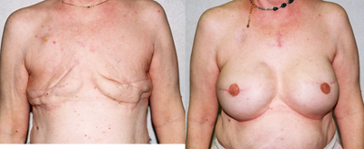 Breast Reconstruction  - Breast Reconstruction