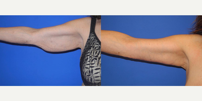 Woman treated with Arm Lift - Woman treated with Arm Lift