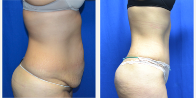 25-34 year old woman treated with Tummy Tuck - 33 year old female 5 months after a tummy tuck. Her height is 5 feet 1 inches and her weight is 153 lbs. She has two children.