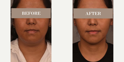 Woman treated with Buccal Fat Removal - Woman treated with Chin/Neck Liposuction, Cheek Liposuction, and Buccal Fat Removal. Patient is shown before and 3 months post-op.