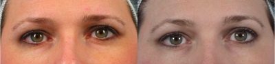 35-44 year old woman treated with Botox for non-surgical brow lift - Botox used to raise the eyebrows without surgery.