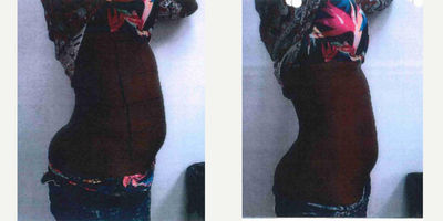 18-24 year old woman treated with Skin Rejuvenation Body Fx & Body Plus - Female preparing for a photo shoot. 1 treatment of Body Fx fat reduction, and Body Plus, skin tightening. Before and after pictures were taken the same day.