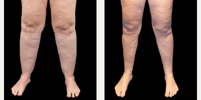 55-64 year old woman treated with Liposuction, Lipedema Surgery - 1-year post-op results from circumferential lipedema liposuction surgery on the thighs, calves, and ankles.