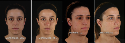 Cheek / Midface Augmentation with Voluma - Patient with mid face deficiency that requested improvement with a non-surgical procedure based on injection of fillers. She underwent mid face augmentation with Voluma (10 syringes), 50 Units of Botox in the forehead, glabella and crow's feet area, and improvement of the nasolabial folds (laugh lines) with Juvederm (2 syringes)