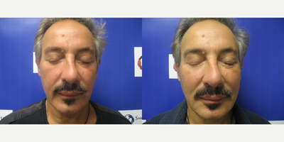 Man treated with Dermal Fillers - Man treated with Dermal Fillers.