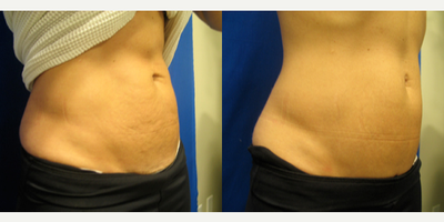 Woman treated with Skin Tightening - Woman treated with Skin Tightening.