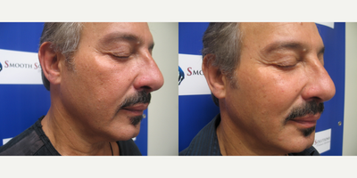 Man treated with Dermal Fillers - Man treated with Dermal Fillers.