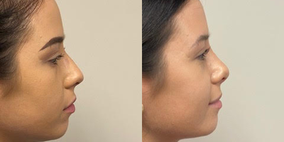 18-24 year old woman treated with Rhinoplasty - Patient shown before and one month after an open rhinoplasty to decrease the top of the nose and raise the tip. All procedures done by Frank J. Ferraro, MD at pssnj.com