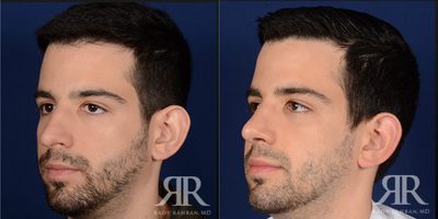 35-44 year old man treated with Septoplasty, Rhinoplasty - Male Septoplasty & Rhinoplasty