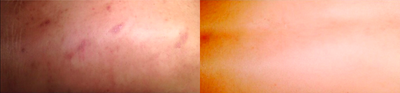35-44 year old woman treated with Microdermabrasion - Back post acne scars treatment with Dermasweep, 4 treatments later