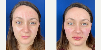 25-34 year old woman treated with Radiesse - Radiesse filler used to provide more definition of jaw line. Patient also received some lip filler.