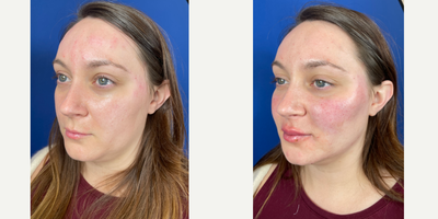 25-34 year old woman treated with Radiesse for Jawline - Patient requested more defined jawline. Dr. Barbarino treated her with 2 syringes of Radiesse to provide more definition. Patient also received lip filler. Photos are immediately before and after procedure.