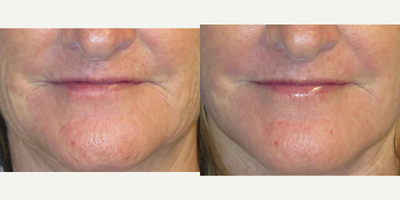 59 year old woman treated with Laser Resurfacing - 59 year old female did not like the fine vertical wrinkles around her mouth.  She had fractional CO2 laser resurfacing.  Note the diminshed appearance of the fine vertical lines above and below the upper and lower lips areas. Also note the decrease in brown spots after the procedure.