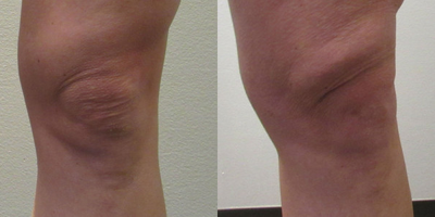 Woman treated with BodyTite - BodyTite