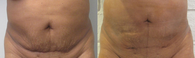 Woman treated with BodyTite - BodyTite