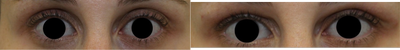 Restylane to upper eyelids to treat hollowing - She desired a reduction in the upper eyelid hollowing (sulcus).  Restylane filler was placed by Dr. Kotlus.