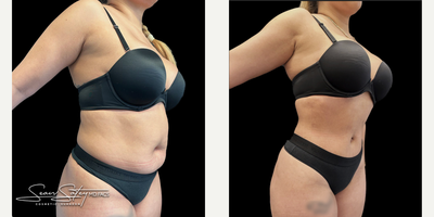 26 year old female treated with VASER Liposuction, Renuvion J Plasma Skin Tightening and post-operative lymphatic massages - 26 year old female who underwent VASER assisted liposculpting and Renuvion J plasma skin tightening of the abdomen, flanks, axilla, upper/middle/lower back; fat grafting to the buttocks and lateral hips (Brazilian Buttock Lift, BBL). Patient underwent 6 post-operative lymphatic massages.