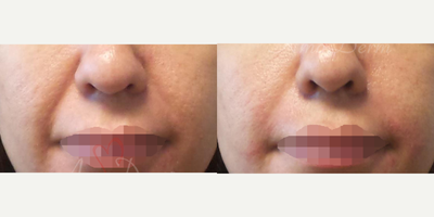 35-44 year old woman treated with Juvederm, Radiesse, Vollure, Restylane, Bellafill - Treatment of nasolabial folds (laugh lines) with Juvederm, Radiesse, Vollure, Restylane or Bellafill injected with cannula