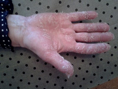 Severe Skin Reaction; Due to Neurodermatitis? (photo) Doctor Answers, Tips