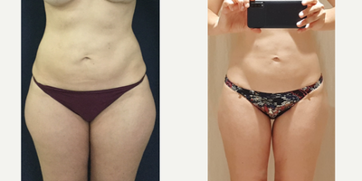 25-34 year old woman treated with Liposuction - Beautiful post op results in this 32 year old patient from Toronto, Canada two months after 360 liposuction and Brazilian butt lift with Premium Care. Surgical time was 2.5 hours using two plastic surgeons, and she spent one week after surgery recovering in Cartagena at our five star Recovery Suites. Her figure looks amazing!