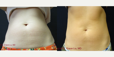 35-44 year old woman treated with Vanquish - 6 45 min Vanquish Treatments to abdomen and love handles