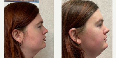 25-34 year old woman treated with Brow Bone Reduction, Forehead Reduction, Brow Lift, Facial Feminization Surgery, Lip Lift, Lip - this is a young lady who underwent forehead feminization, chin feminization, and lip surgery.