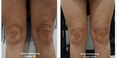 Woman treated with Fractional Laser, Skin Tightening - Knee contouring using my trademark technique MINI-SIF these results required 2 procedures. Knees are very (very) hard to fix. This pt had a non-invasive treatment done with the intent of skin tightening  and it left her with not only soft tissue loss but also skin discoloration due to severe underlying scarring.Pt had severe anxiety over the way her knees appeared after that treatment. DM me plz if u wanna know more about these results revision surgery.