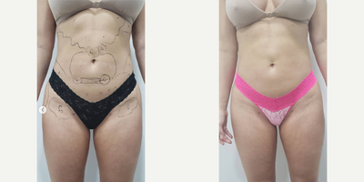 Woman treated with Liposuction Revision - BBL craze is starting to get old, I think I've now revised a few cases of BBL restoring patients back to their original shapes. But that's not all I did for this patient, Revision Liposuction and fat grafting using my trademark technique mini-sif. Its only 2 weeks postop but her results are pretty remarkable.