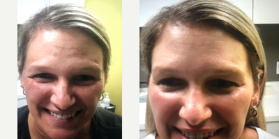 25-34 year old woman treated with Cosmelan - 25-34 year old woman treated with Cosmelan for melasma on forehead and malar region