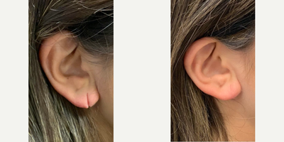 Woman treated with Earlobe Repair - Woman treated with Earlobe Repair