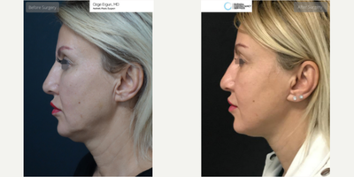 35-44 year old woman treated with Neck Lift - Neck Lift