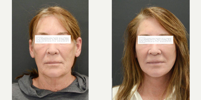 65-74 year old woman treated with Facelift, Lower Facelift, Neck Lift, Lifestyle Lift - Dr Fink performed a Newport Facelift, consisting of Smas Lift and Platysmaplasty of her neck. The results are natural and she looks like a natural and refreshed version of her younger self.