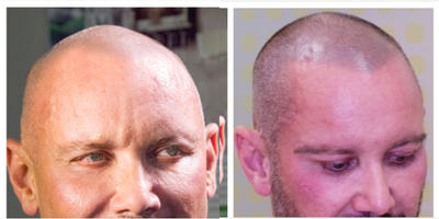 45-54 year old man treated with Scalp Micropigmentation - 45-54 year old man treated with Scalp Micropigmentation to his hairlineHe also had FUE hair transplant to his Eyebrows