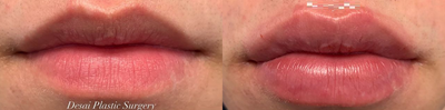 Man treated with Lip Augmentation - Man treated with Lip Augmentation