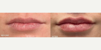Woman treated with Lip Fillers - Woman treated with Lip Fillers