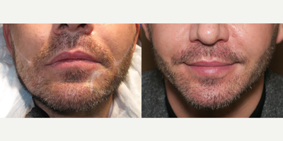 Man treated with Beard Transplant - Man treated with Beard Transplant- 6 months post-op