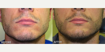 Man treated with Beard Transplant - Man treated with Beard Transplant